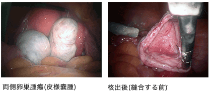 卵巣腫(Total Laparoscopic Cystectomy)