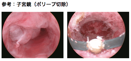 参考:子宮(ポリープ切除)